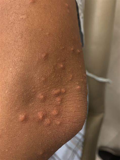 Penyakit Xanthoma - Definisi, Penyebab, Gejala, dan Tata Laksana | AI Care