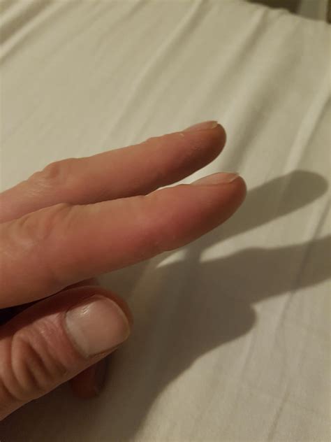 Clubbed Fingers In French at Anna Beyers blog