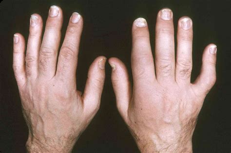 Pictures of Psoriatic Arthritis: What It Looks Like