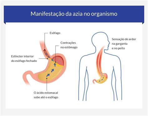 O Que Causa Azia E Queimação Na Garganta