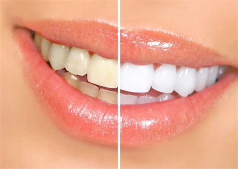 The Truth About Teeth Whitening: Separating Fact From Fiction - The