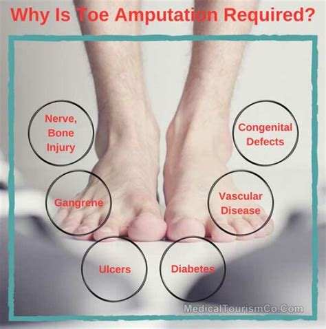 Toe Amputation Surgery Abroad