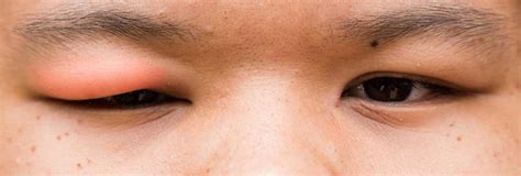 swollen eyes  optometrist  toronto dr dorio