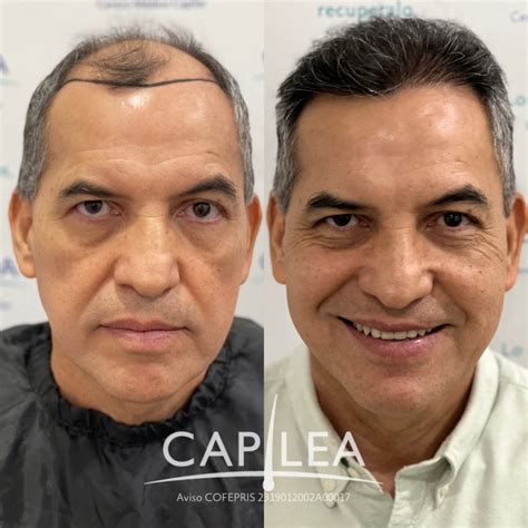 Hair transplant before and after