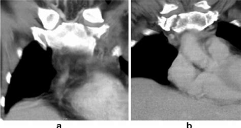 B Mirror injury ^ : oblique fracture of the manubrium in a driver and a... | Download Scientific ...