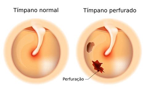 Como Saber Se Estourei O Timpano