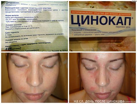 Себорейный дерматит (себорея): лечение народными средствами