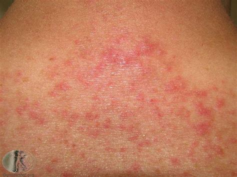 skin rashes