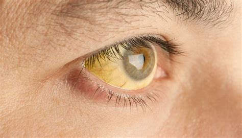 Anemia Deixa O Olho Amarelo - Anemia Eyes