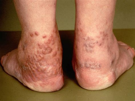 Erythema Elevatum Diutinum Images