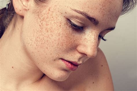 Freckles On Face Remove at Home:Skin Care Top News