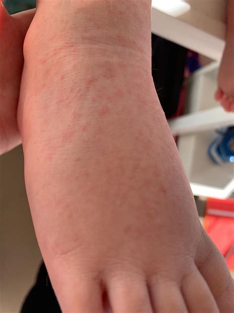 Foot And Mouth Disease In Children