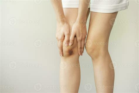 Close up of stain bruise wound on leg, contusion asian young woman, girl on joint knee from an ...