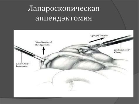 Острый аппендицит - презентация онлайн