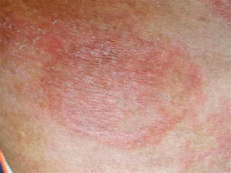 Fotografia Do Verme-agulha E De Doenças Cutâneas. Infecção Por Fungos ...