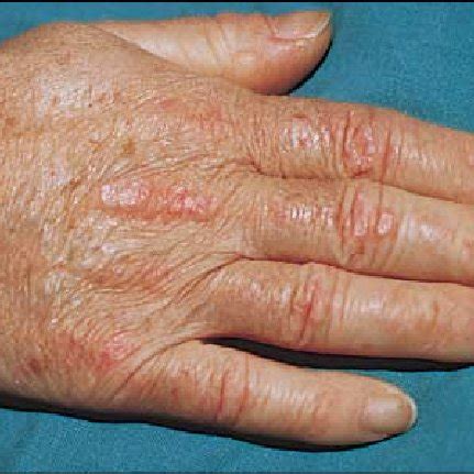 Gottron sign: symmetric violaceous erythema overlying the dorsal aspect ...