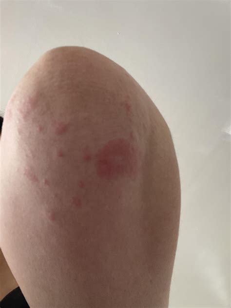 psoriasis or ring worm? : r/DiagnoseMe