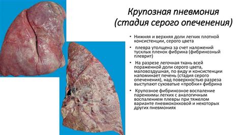 Острые пневмонии, ХНЗЛ, пневмоканиозы. Макропрепараты - online presentation