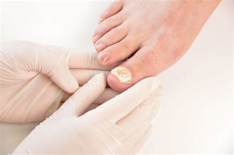 Fungal Nails - Gray Foot and Orthotic Clinic