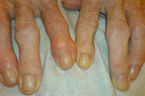 gout  osteoarthritis difference  comparison diffen