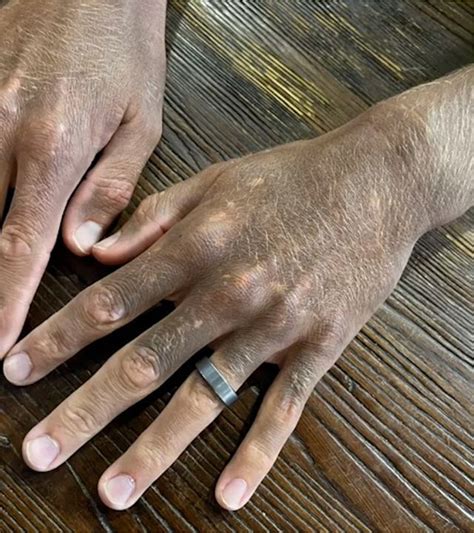 Man's skin turns black from reaction to antidepressant Prozac | New