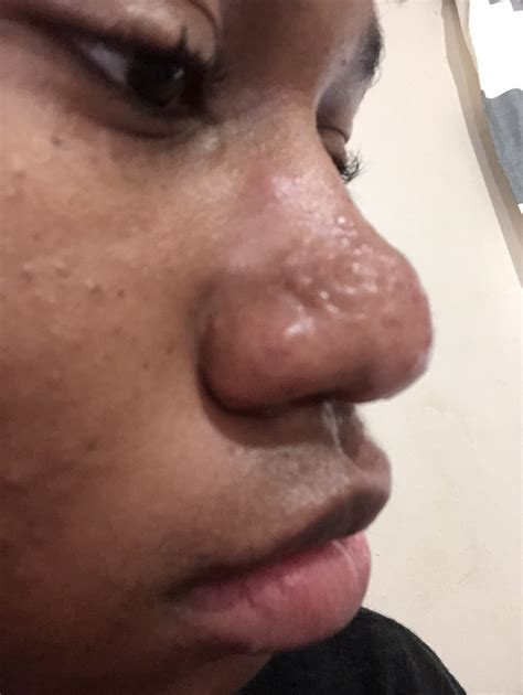 Raised Hypertrophic Nose Acne Scars. Help me plzzz – Hypertrophic