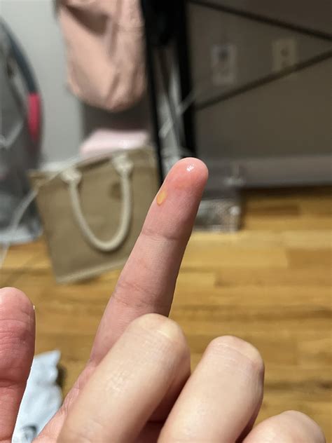 Weird yellow liquid leaking from my nose? : r/DiagnoseMe