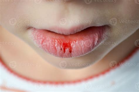 Dry and damaged lips of a girl 51136541 Stock Photo at Vecteezy