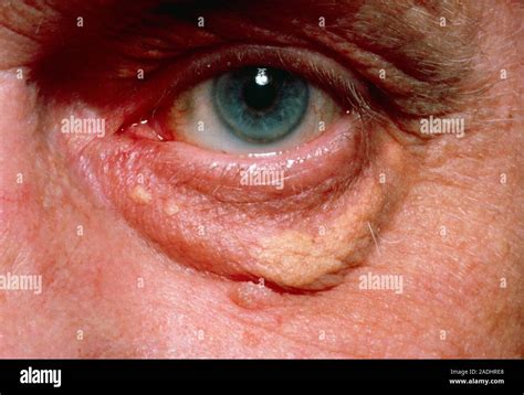 Xanthelasma: a yellowish swelling of the lower eyelid resulting from ...