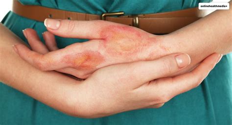 What Are Burns? Symptoms, Treatment, And Prevention