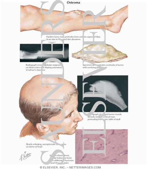 Osteoma