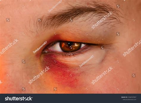 Eye Injury Male Black Eye Isolated Stock Photo 1598707897 | Shutterstock