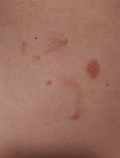 Jellyfish stings from Roatan, Honduras. I didn't feel anything sting me