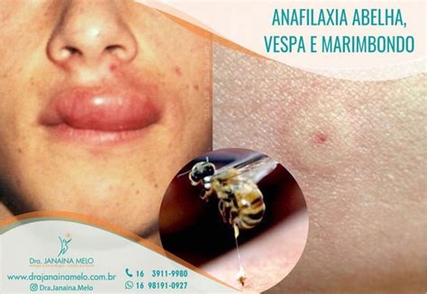 Alergia A Picada De Abelha - Infeccaoporpicadadevespa