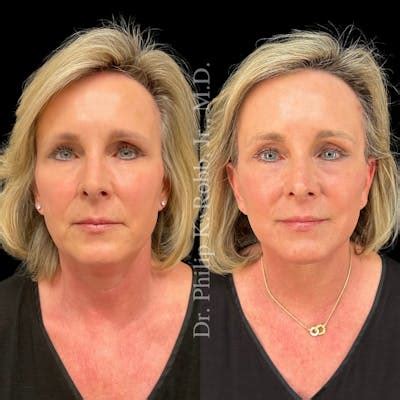 Buccal Fat Reduction Before & After Photos | Robb Facial Plastic Surgery