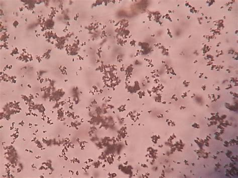 Bacteria in Urine Sediment Crystals