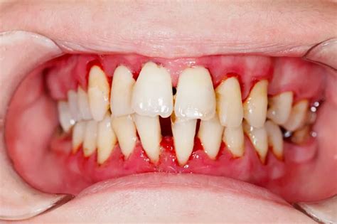 Viêm nha chu là gì? Cách phòng ngừa và điều trị viêm nha chu
