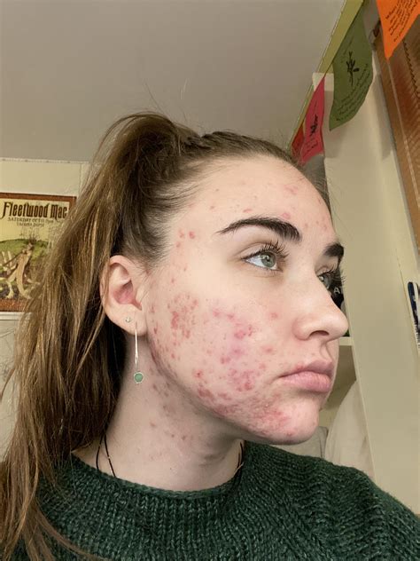 Accutane Defeitos Congenitos Conehead Rate #1, Best Ranking System:
