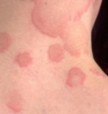 Syphilis Face Rash