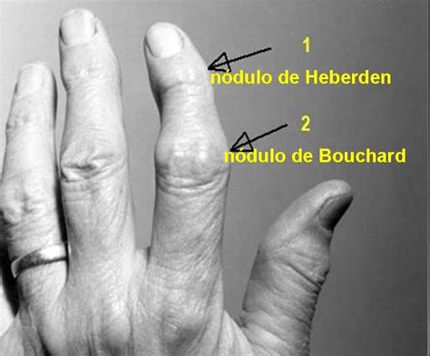Nodulos De Bouchard E Heberden