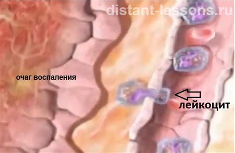 Воспалительный процесс | Дистанционные уроки