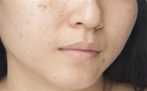 How to get rid of post acne marks - Exclusive Skin Care
