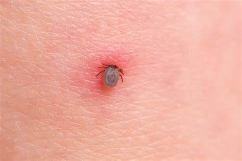 Do Dog Ticks Bite Humans