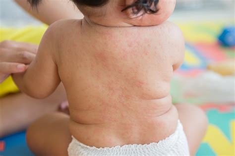 Rubéola: sintomas, transmissão e prevenção - Vitat