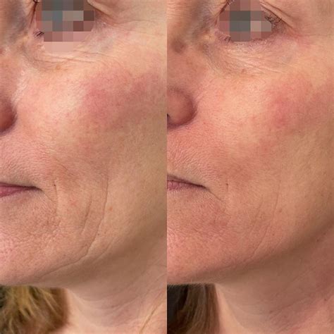 PRX-T33 NO-NEEDLE BIOREVITALISATIE