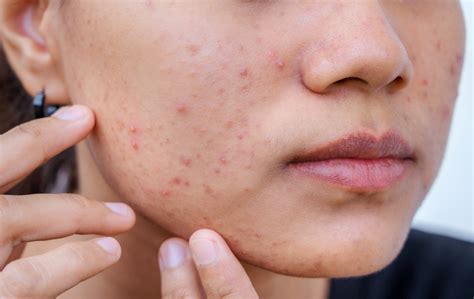 treat acne  pimples  face