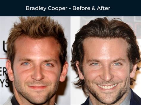 celebrity hair transplants