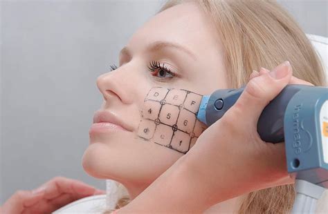 Что такое процедура Термаж (Thermage): описание и подробности - GlobalSib