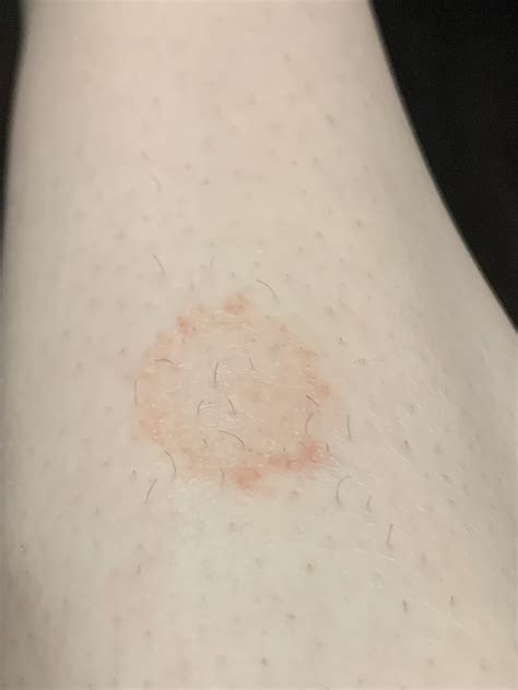 Does this look like ringworm? It is not itchy. It’s on my leg. : r