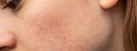 closed comedones identifying  treating comedonal acne strut blog